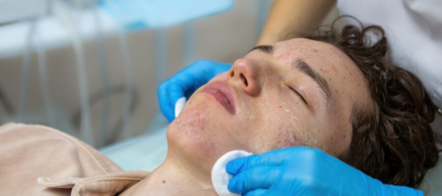 Acne Treatment in Mumbai