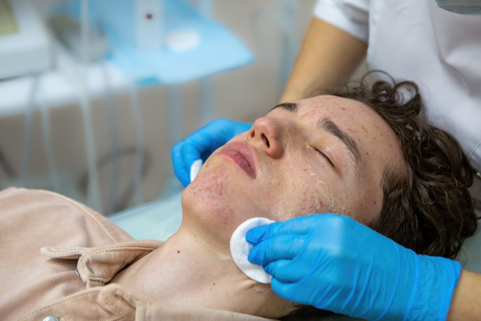 Acne Treatment in Mumbai