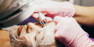 Benefits of Laser Treatment - Midas Aesthetics