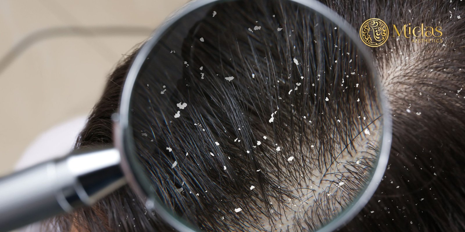 12 tips to get rid of dandruff in winter - Midas Aesthetics