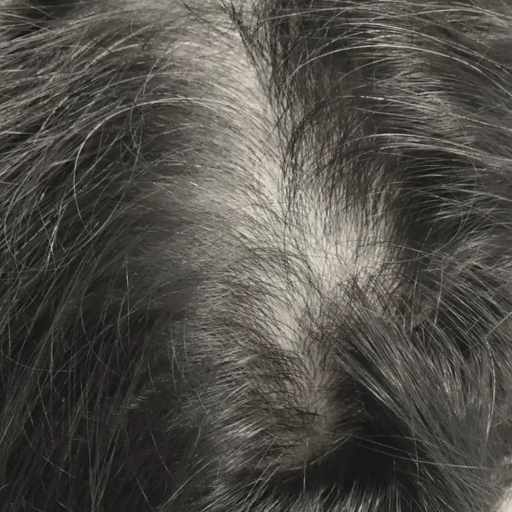 Hair Thinning Treatment Before - Midas Wellness Hub