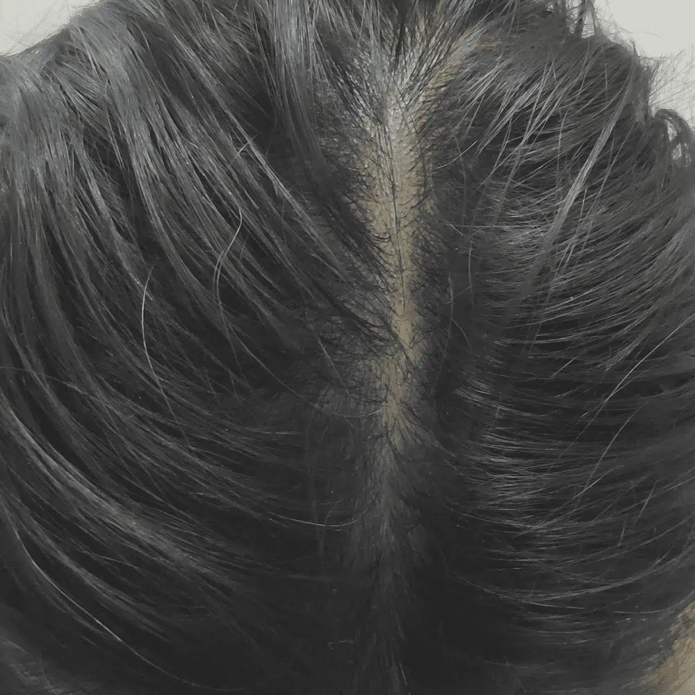 Hair Thinning Treatment After - Midas Wellness Hub