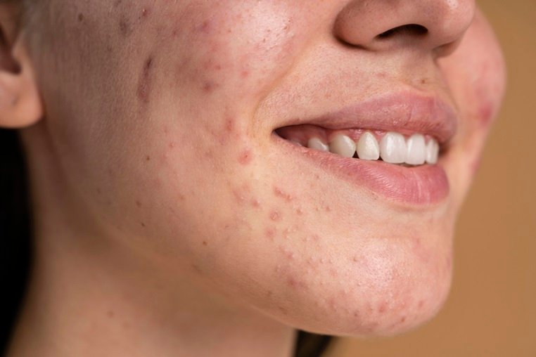 How to remove acne scars from face permanently - Midas Wellness Hub