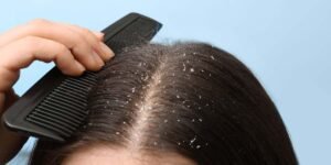 Dandruff Treatment in Mumbai - Midas Wellness Hub