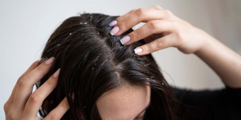 Get Rid of Dandruff - Midas Wellness Hub