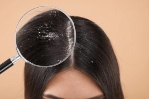 Scalp Health & Hair Growth: How to Treat Dandruff, Itchy Scalp & Hair Fall