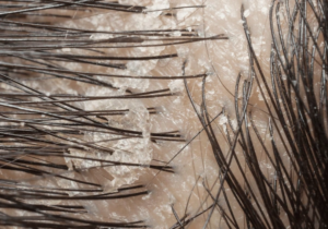 Dandruff vs. Dry Scalp: How to Tell the Difference & Treat It Right