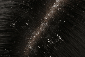 Dandruff vs. Dry Scalp: How to Tell the Difference & Treat It Right