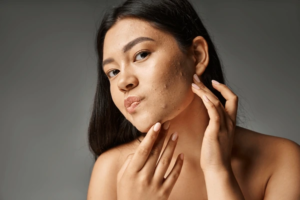 How Gut Health Affects Your Skin: The Connection Between Digestion & Acne