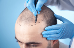 Hair Transplant at Midas Wellness Hub: The Ultimate Solution for Hair Loss