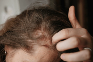 Scalp Sensitivity and Hair Fall: Are They Connected?