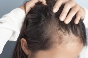 Is Minoxidil Really Safe for Hair Loss? The Truth You Need to Know