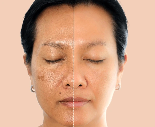 Dark Circles, Pigmentation, and Early Wrinkles: