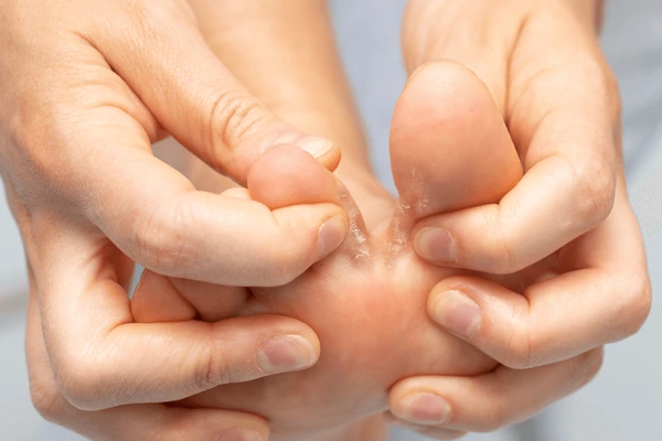 Fungal Skin Infections Are Booming in Mumbai’s Monsoon