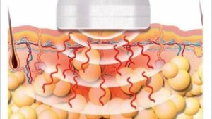 Reclaim Your Confidence with Ultrasound Cavitation: Mumbai’s Non-Surgical Solution