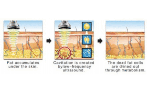 Reclaim Your Confidence with Ultrasound Cavitation: Mumbai’s Non-Surgical Solution