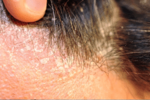 Does Ayurvedic Oil Massage Help with Hair Fall? Debunking the Myths 