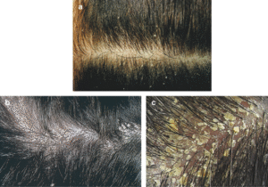 Dandruff and Hormonal Imbalances: What’s the Link?