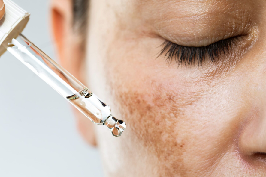 Melasma Treatment in Borivali: Trending Solutions at Midas Wellness Hub