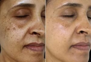 Benefits of Black Peel Treatment at Midas Wellness Hub