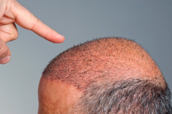 Disadvantages of Hair Transplant – Try Midas Hair Treatment in Borivali Instead