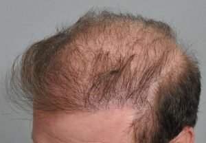 Disadvantages of Hair Transplant – Try Midas Hair Treatment in Borivali Instead