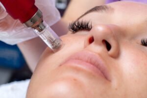 Acne Scars: Microneedling vs. Chemical Peels – Which Is Better?
