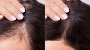 5 Real Signs That You’re Ready for Exosome Hair Therapy in Borivali