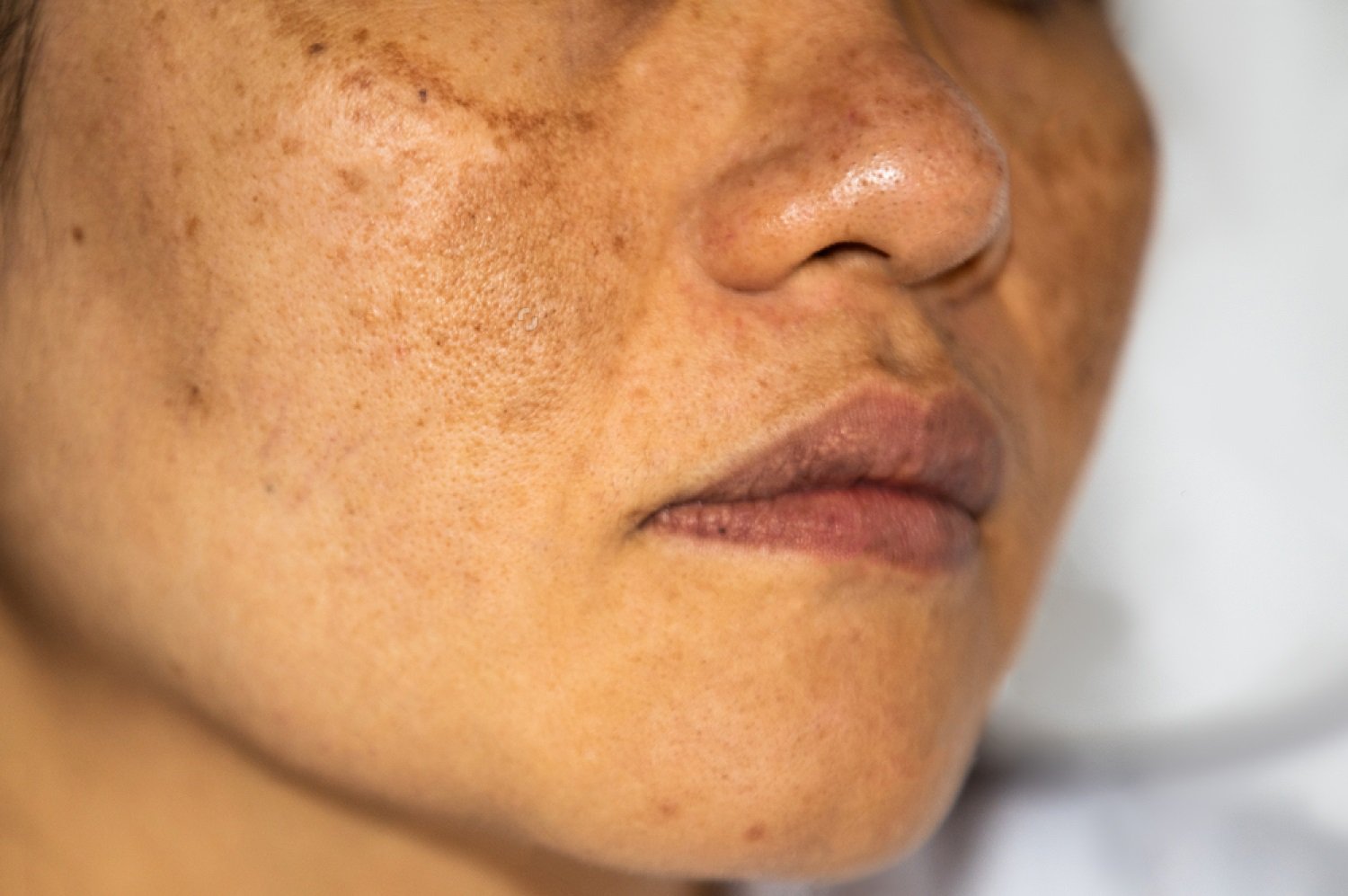 Understanding Pigmentation: Causes, Treatments & Skincare Tips