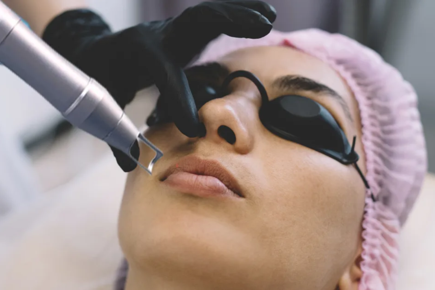 Pico Lasers – The Fastest Route to Pigmentation-Free Skin