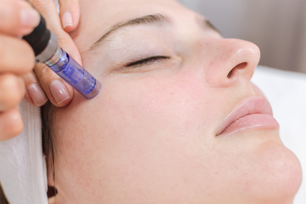 Micro Needling - Midas Wellness Hub