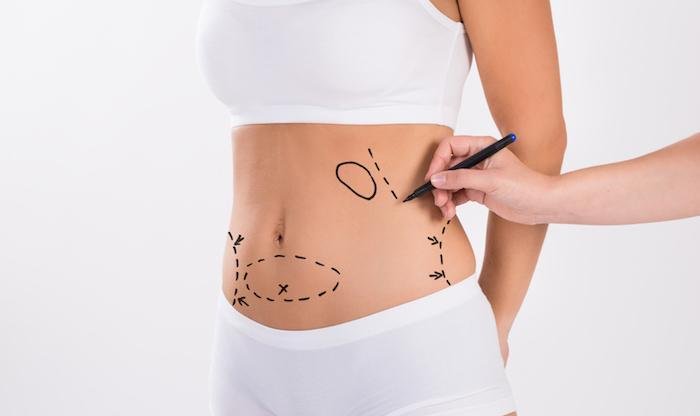 Best Areas for Lipo Laser: Sculpting Your Body Safely and Effectively