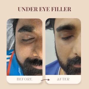 Dermal Fillers | Midas Wellness Hub