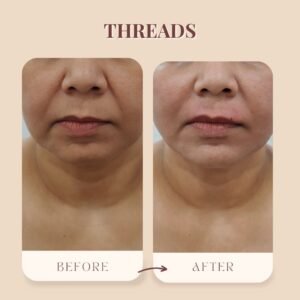 Threads :Before After| Midas Wellness Hub