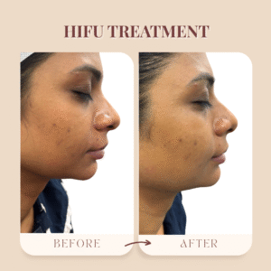 Why HIFU Is the Best Skin Tightening Treatment for Loose Skin