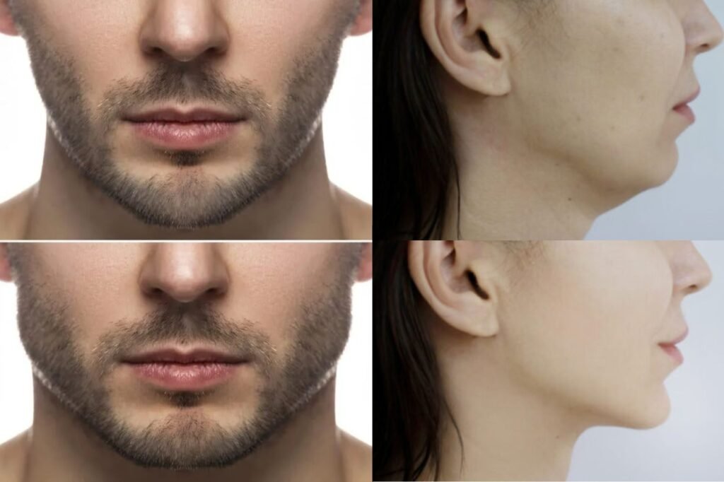 Masseter Botox for Men vs. Women: What’s the Difference?