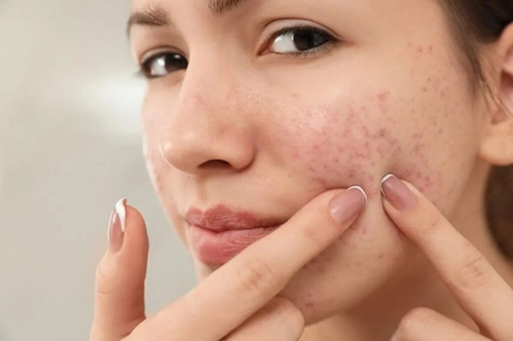 Clear Skin Naturally: The Power of Turmeric Supplements, Diet & Advanced Treatments for Acne and Scars