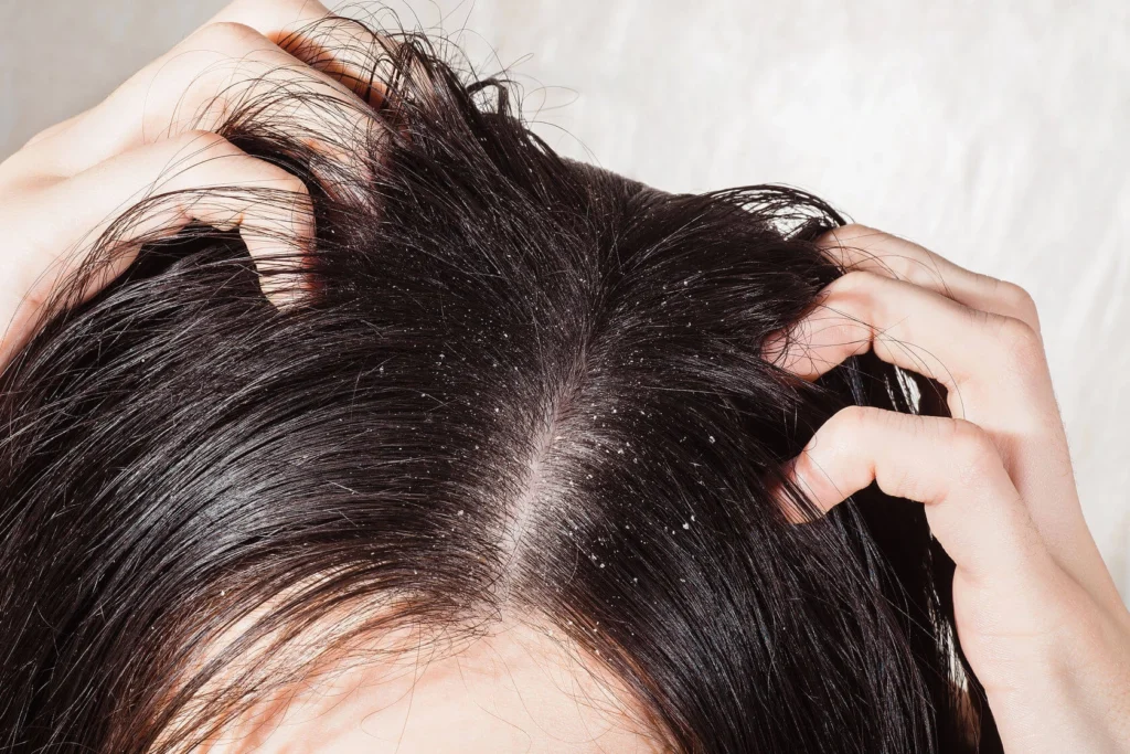 Organic Dandruff Treatment: Heal Your Scalp & Boost Hair Growth Naturally