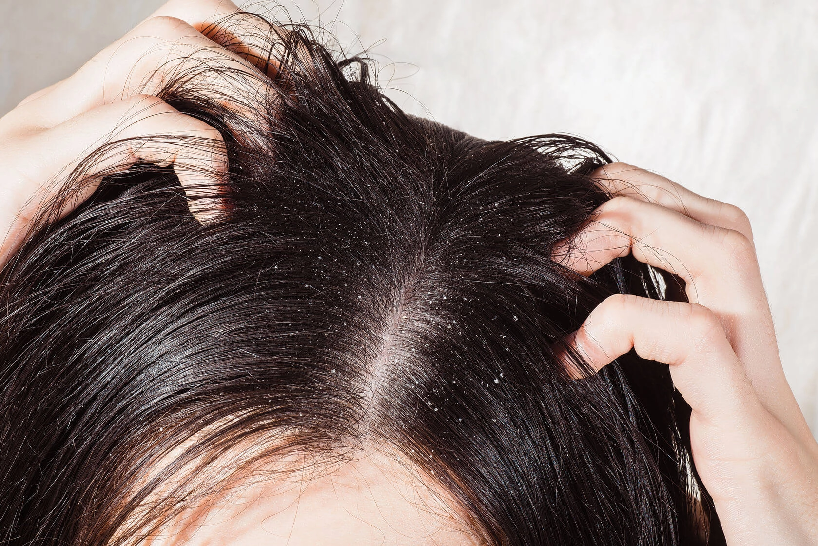 Organic Dandruff Treatment: Heal Your Scalp & Boost Hair Growth Naturally