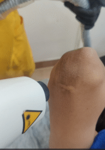 Laser treatments | Midas Wellness Hub