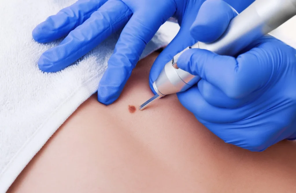 Skin Tag Removal for Sensitive Areas at Midas Wellness Hub (Neck, Eyelids, Underarms, Groin)