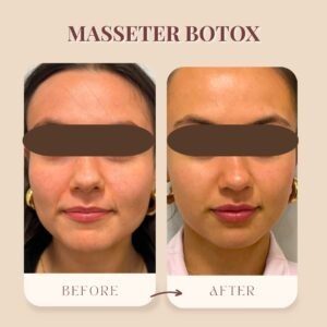 Masseter Botox for Men vs. Women: What’s the Difference?