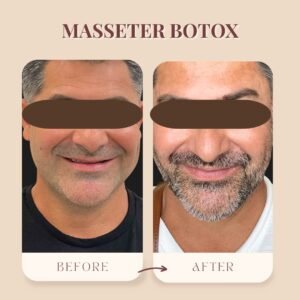 Masseter Botox for Men vs. Women: What’s the Difference?