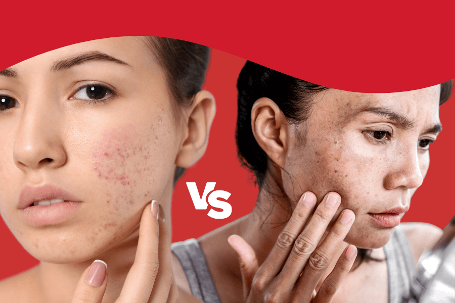 Types of Acne and Hyperpigmentation: Causes, Effects, and Treatments