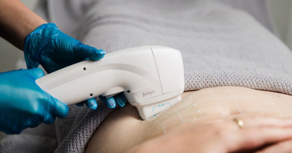 HIFU vs. RF: The Best Non-Surgical Treatments for a Firmer Bum
