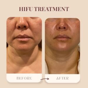 Tummy Tightening Revolution at Midas Wellness Hub: HIFU + RF + EMS for Women