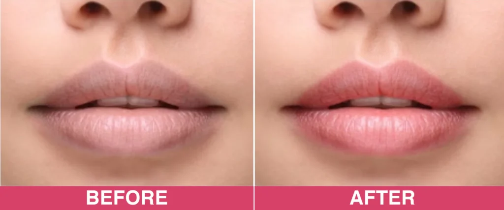 banner_e1ce115f-83f5-4f6d-ba03-a0a6937ee6ab Lip Pigmentation Due to Smoking: Causes, Treatments, and How to Control It