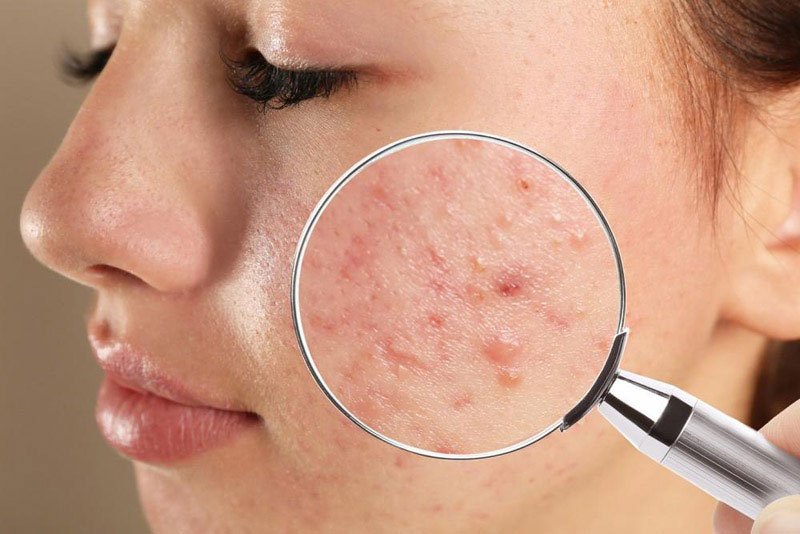 Types of Acne on Different Skin Types and How to Treat Them with Midas Wellness Hub
