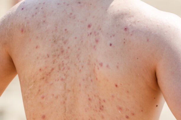 Back and Thigh Acne: Why It Happens and How to Treat It the Right Way