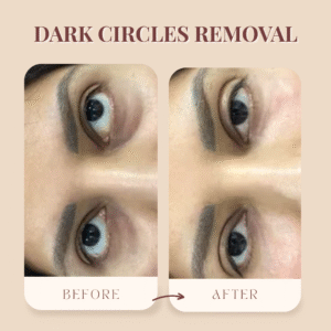 Under-Eye Wellness Solutions for Puffiness & Dark Circles